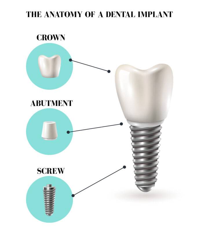 Dental Implants